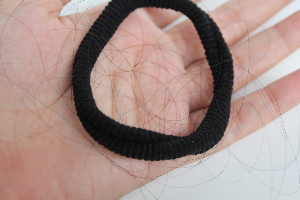 alopecia por tração