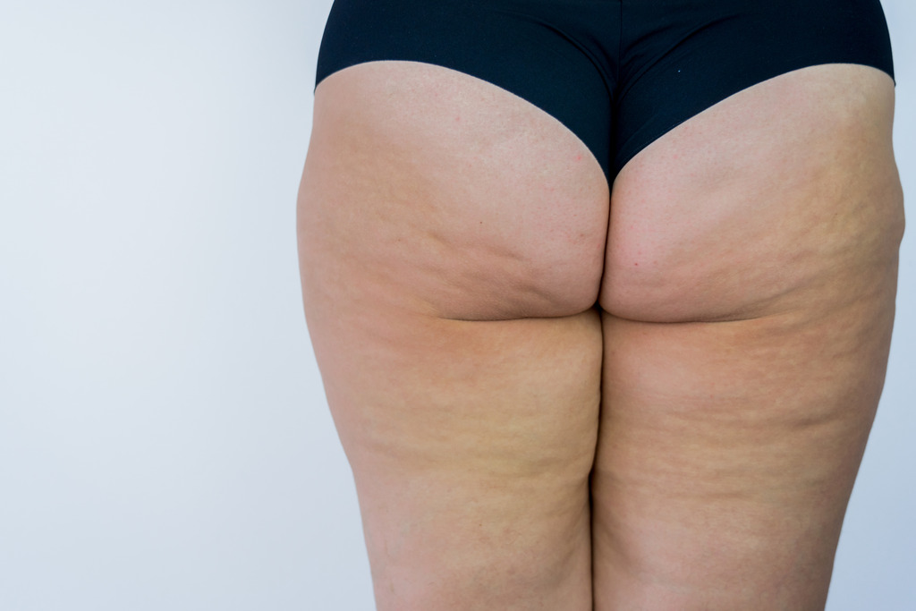 sintomas celulite bacteriana 